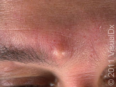 Epidermoid cysts can appear as a visible lump, and people often note that they feel much larger than they look.