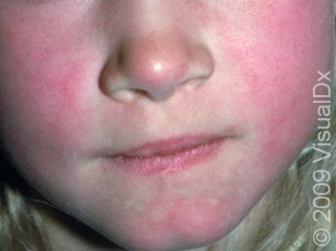 The first stage of erythema infectiosum includes firm, red cheeks that feel warm, appearing like 