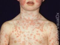 Fifth Disease (Erythema Infectiosum)