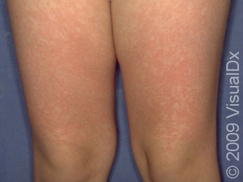 This image displays red, fluid-filled bumps typical of fifth disease.