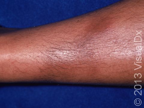 This image displays a deep red inflammation typical of erythema nodosum.