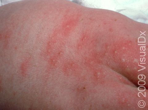 The pus-filled lesions (pustules) of erythema toxicum neonatorum form within areas of pink or red skin.