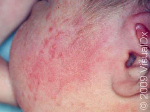 This infant with erythema toxicum neonatorum has scattered pink lesions typical of this rash.