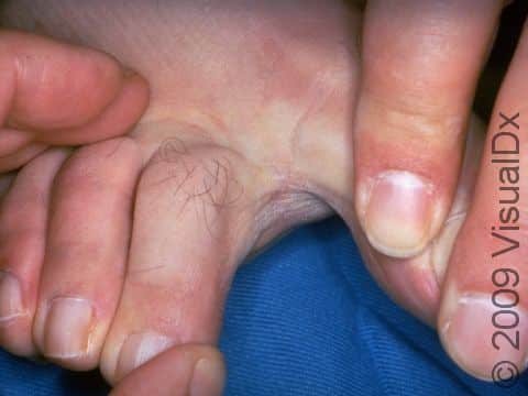 This image displays a bacterial skin infection between the toes typical of erythrasma.