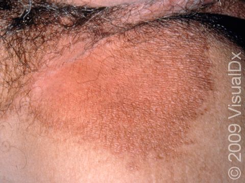 This image displays a scaly rash typical of erythrasma, a bacterial skin infection common in body folds.