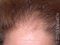 Hair Loss, Female Pattern Baldness (Female Pattern Alopecia) – Adult