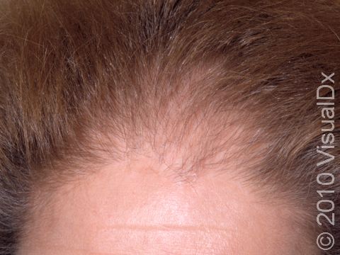 In female pattern alopecia (balding), there is often thinning at the front of the scalp.