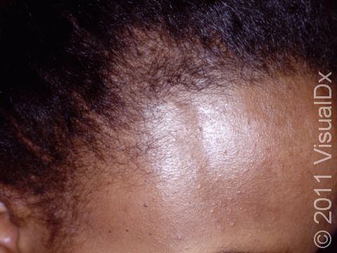 Hair Loss, Female Pattern Baldness (Female Pattern Alopecia) Condition,  Treatments and Pictures for Adults - Skinsight
