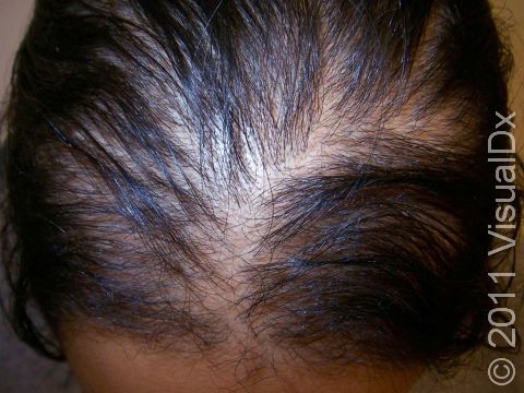 Hair Loss, Female Pattern Baldness (Female Pattern Alopecia) Condition,  Treatments and Pictures for Adults - Skinsight