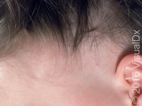 In female pattern alopecia (balding) the scalp is entirely normal but there is noticeable hair thinning.