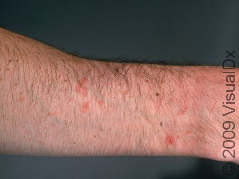 Flat warts can appear pink or slightly red, as displayed in this image.