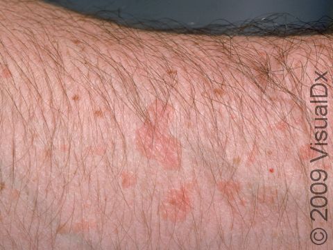Flat warts can appear pink and sometimes broad in shape, as displayed in this image.