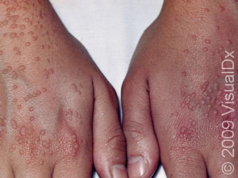 This image displays typical, multiple flat warts.