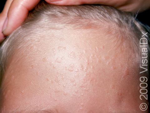 Numerous skin colored flat warts are seen here on the forehead.