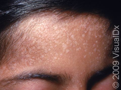 In people with darker skin, flat warts can look lighter in color than normal skin.