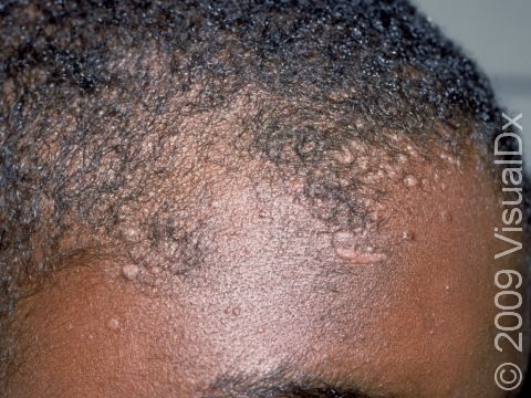 This image displays numerous flat warts on the forehead.