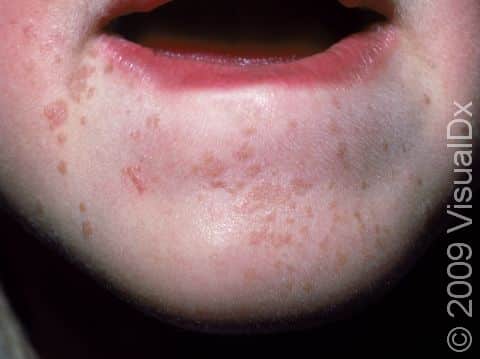 Flat warts are not as raised as common warts; when they are numerous, as on the chin of this child, they can simulate a rash.