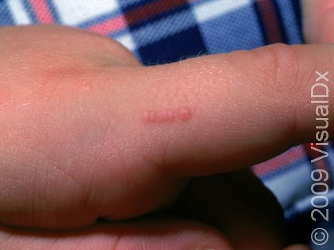 In lighter skinned people, flat warts are pink in color. The straight line of warts displays the spread of the virus from a scratch.