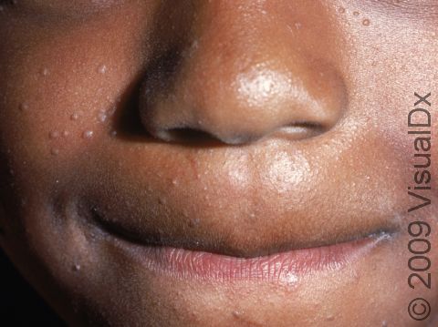 Flat warts can be widely scattered across the face.
