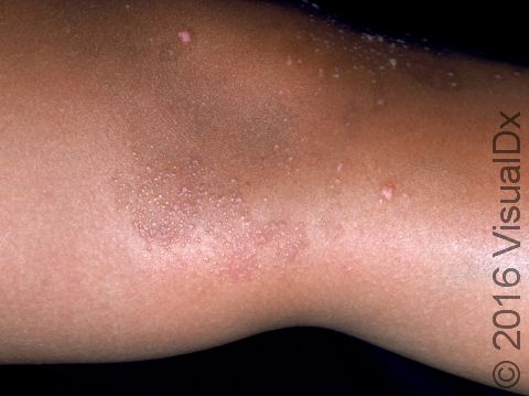 Flat warts may be difficult to see in darker skin and often have a lighter color than normal skin.