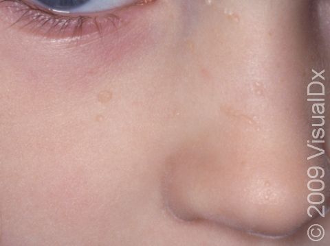 This child has small, skin-colored flat warts at the cheek below the eye and on the nose.