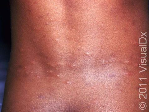 This image shows flea bites on the trunk. The redness of the bites can be difficult to appreciate in darker skin. 