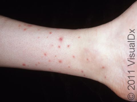 Small bug bites that occur on the ankles are often due to fleas. 
