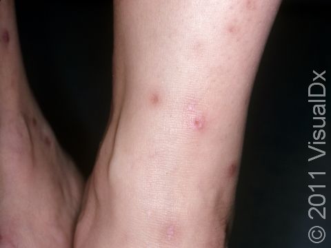 These bumps on the ankle were caused by flea bites. 