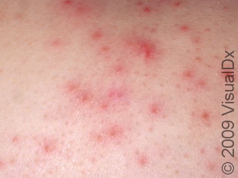 This image displays red bumps centered on hair follicles typical of folliculitis.