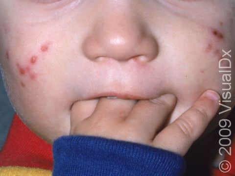 Each of the small red bumps or pus-filled lesions of folliculitis start around a hair follicle. This child has several lesions on the cheeks, which look similar to acne.