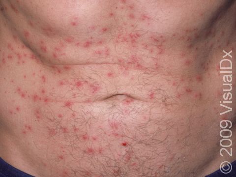 This image displays numerous hair follicles that have been infected with bacteria, causing folliculitis.