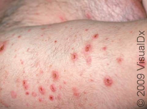 This image displays small pus-filled lesions of folliculitis that have dried up and been scratched.