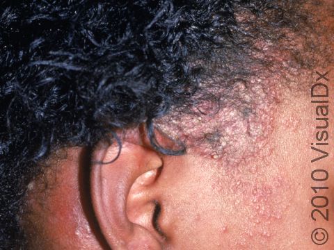 Staphylococcal folliculitis is found on the scalp and cheek.