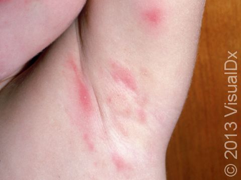 Folliculitis Condition, Treatments and Pictures for Infants - Skinsight