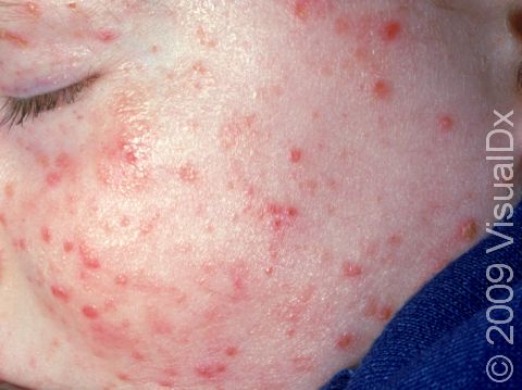This image displays the widespread distribution typical of folliculitis.