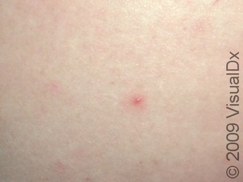 This image displays a single small, pus-filled lesion of folliculitis.