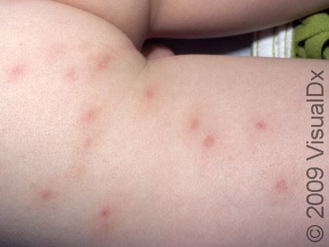 Red bumps (non-pus-filled) centered on the hair follicle are typical of folliculitis.