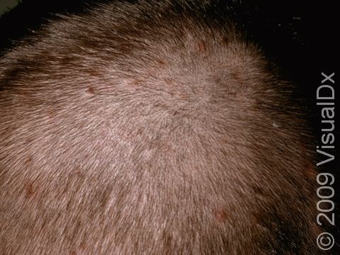 The lesions of scalp folliculitis can be very itchy, resulting in scratching and scabs.