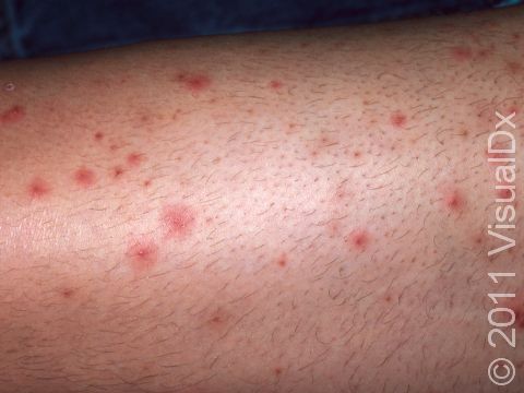 Folliculitis Condition, Treatments and Pictures for Teens - Skinsight