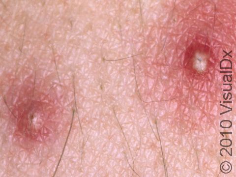 These are the pus-filled lesions typically seen in folliculitis.