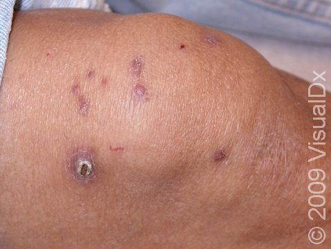 Folliculitis Condition, Treatments and Pictures for Adults - Skinsight