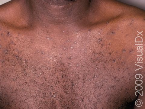 This image shows a typical case of folliculitis.