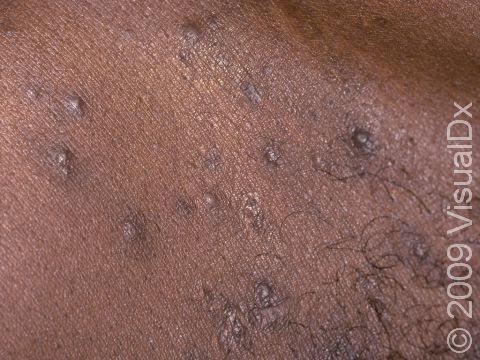 This image displays a close-up of folliculitis.