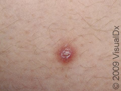 The lesions of folliculitis may have a slight crust on top.