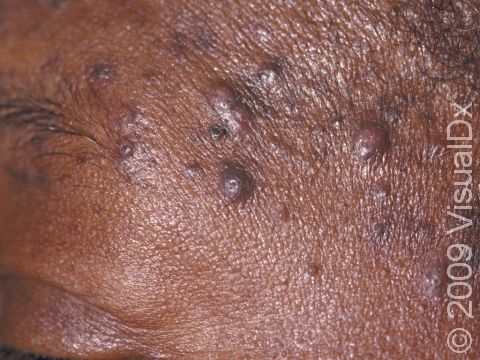 The lesions of folliculitis may be pus-filled, signifying an infection.