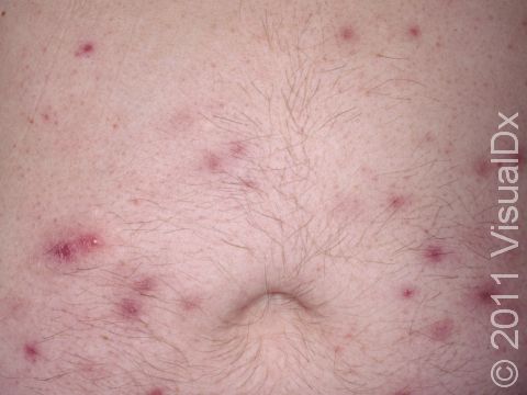 This image shows lesions of folliculitis in different stages of healing. The red bumps are newer and active, while the brown spots are older. 