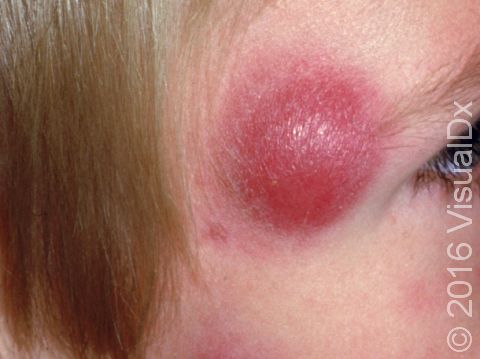 Boils (Furunculosis) Condition, Treatments and Pictures for Children -  Skinsight