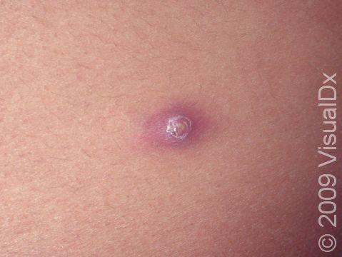 This close-up of a furuncle (boil) displays CA-MRSA (community-associated methicillin-resistant Staphylococcal aureus), confirmed by culture of the affected area.