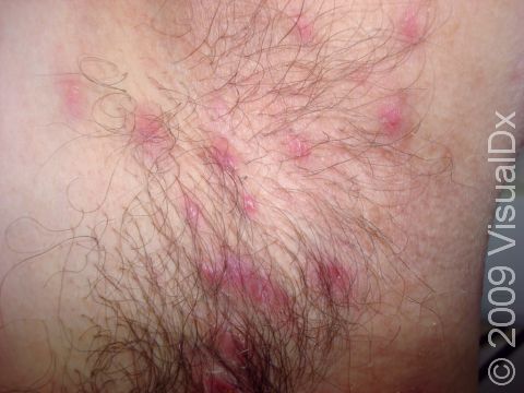A teenage male with furunculosis (boils) displays CA-MRSA (community-associated methicillin-resistant Staphylococcal aureus), as confirmed by culture of the affected area.