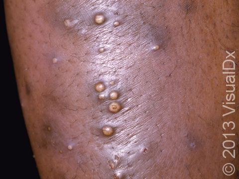 This person developed several furuncles (boils) and pustules on the leg.